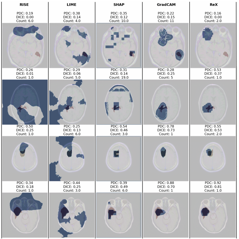 Explainable AI for the Classification of Brain MRIs